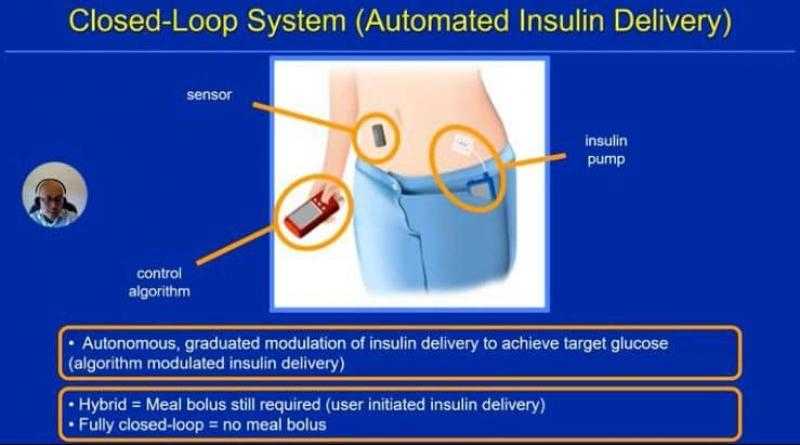 الكشف عن جهاز البنكرياس الصناعي لقياس السكر وقت النوم وينهي عمليات وخز الابر